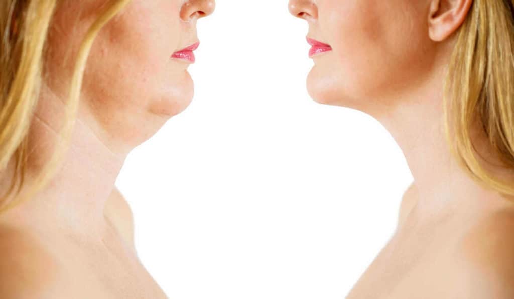 Double Chin treatment Marlborough before and after results