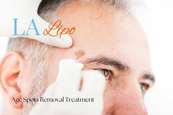 What Are the Most Effective Treatments for Age Spots Marlborough?