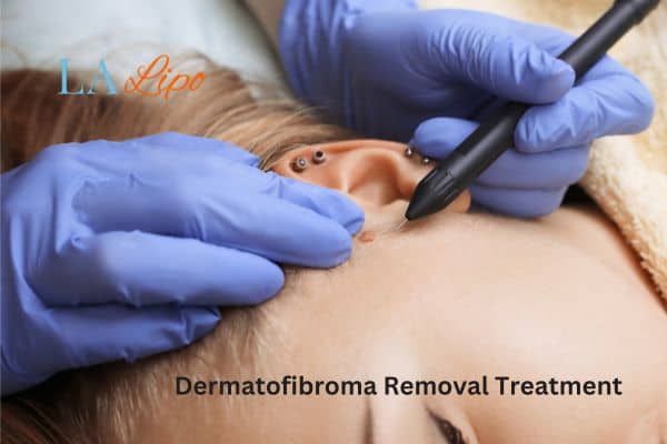Dermatofibroma Removal Treatment Marlborough