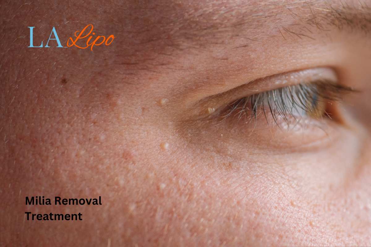 Cryopen Milia Removal: Is It the Easiest and Safest Option Marlborough?