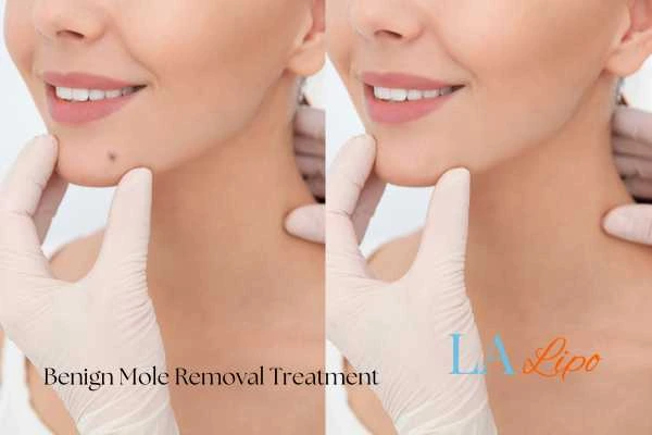 Before-and-after results following benign mole-removal treatment Marlborough