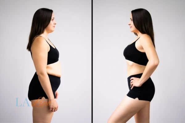 image of woman before and after results of LA-EMS Body Sculpting Marlborough to help treat Diastasis recti