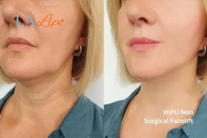 hi-fu for wrinkles Marlborough before and after results