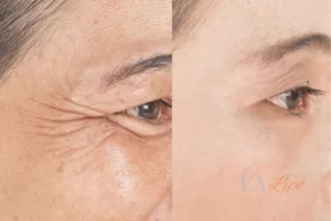 Before and after results of woman - HI-fu wrinkles reduction treatment Marlborough