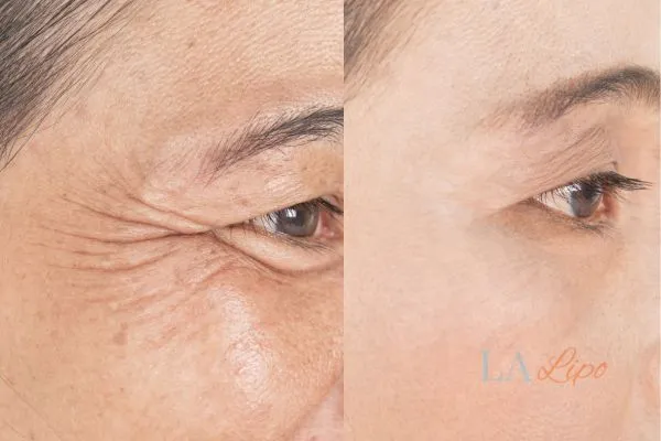 Before and after results of woman - HI-fu wrinkles reduction treatment Marlborough