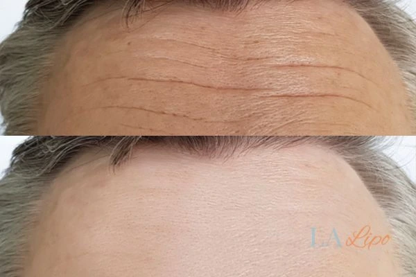 results of HIFU Marlborough on mans forehead to help reduce lines and wrinkles
