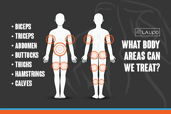 Graphic to show areas you can have LA-EMS Body Sculpting Marlborough treatment.