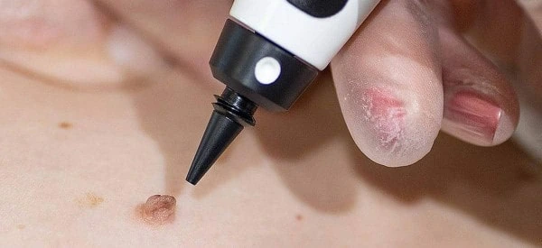 skin tag removal using cryopen Marlborough