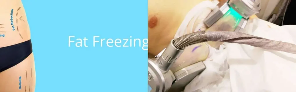 multi areas of a persons body having coolsculpting Marlborough treatment