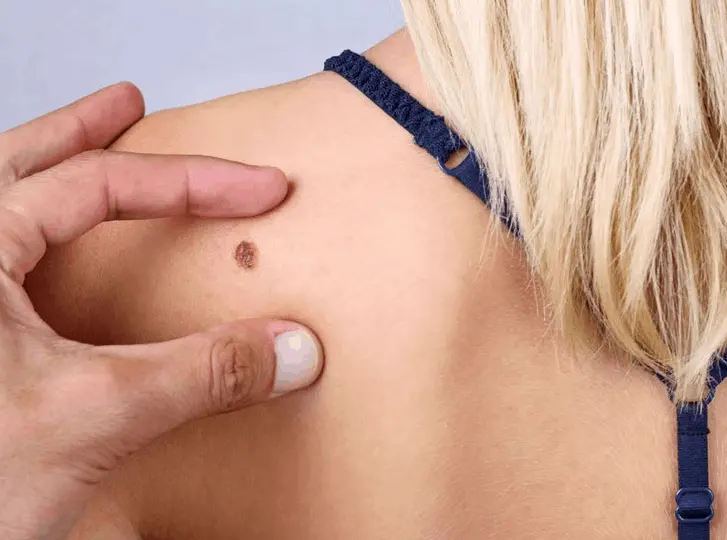 woman having mole removal Marlborough consultation before treatment.