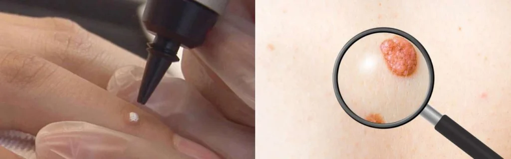 CryoPen practitioner Marlborough assessing a benign mole before treatment