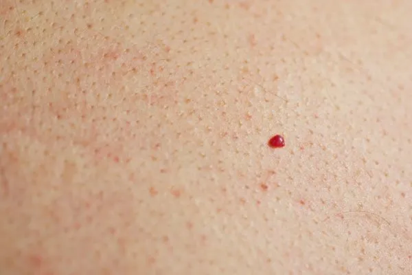 close up of a cherry angioma Marlborough