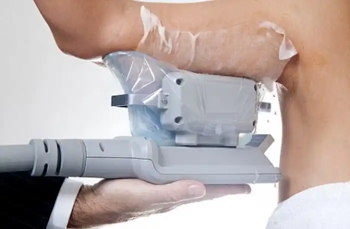 Picture of fat freezing Marlborough on the upper arms.