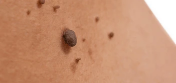 image of a skin tag Marlborough