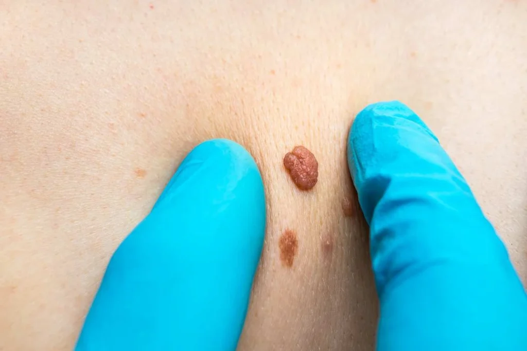 Consultant examining a skin tag Marlborough