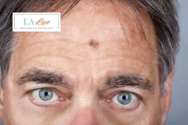 Solar Lentigo Removal Marlborough image of man with mark on his forehead