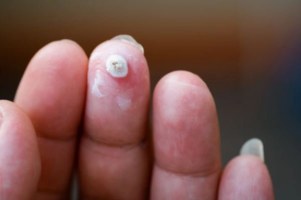 wart on person finger - cryotherapy to treat from LA LIPO Marlborough