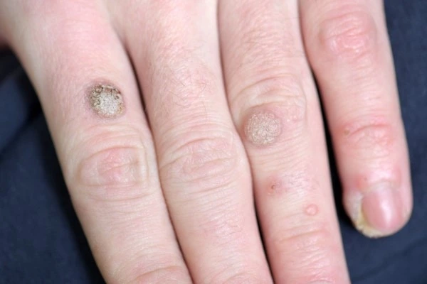 photo of warts on person hand - see wart removal Marlborough from LA LIPO