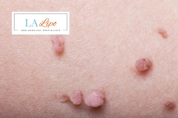 Does cryopen skin tag removal Marlborough hurt? Find out now call our team today!