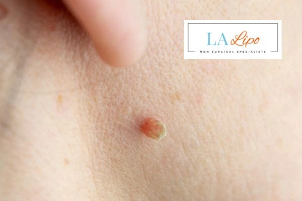 Book skin tag removal Marlborough today speak to our team now!