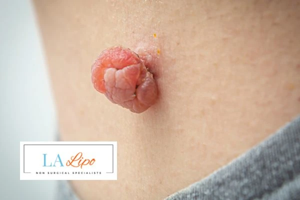 Interested in skin tag removal Marlborough? Concerned about the pain? Find out more today!