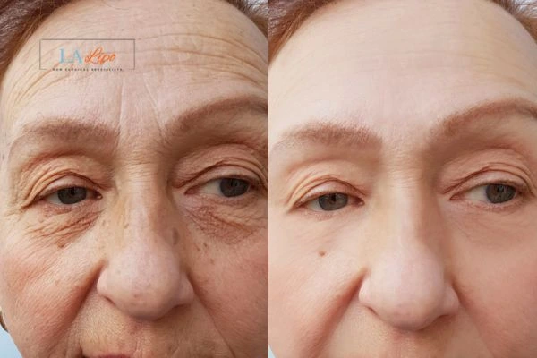 The powerful benefits of Morpheus8 Treatment Marlborough - Call Our team today!