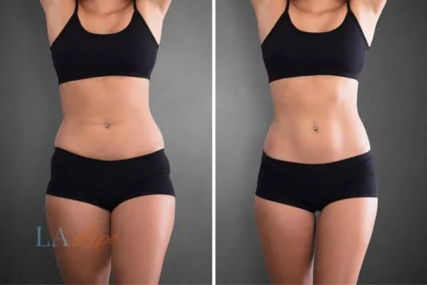 before and after results of non-surgical treatment to help a woman's body image and mental health Marlborough