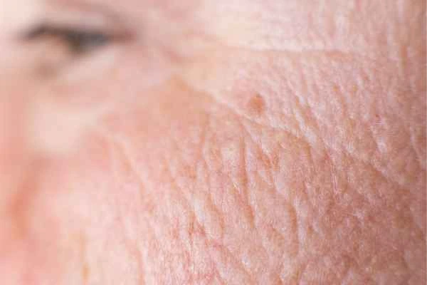 close up picture of a woman's face showing an age spot Marlborough