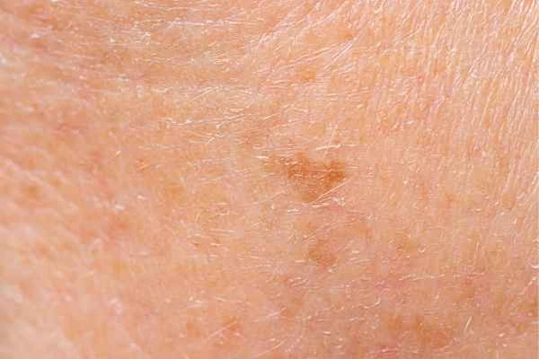 close up picture of age spots Marlborough