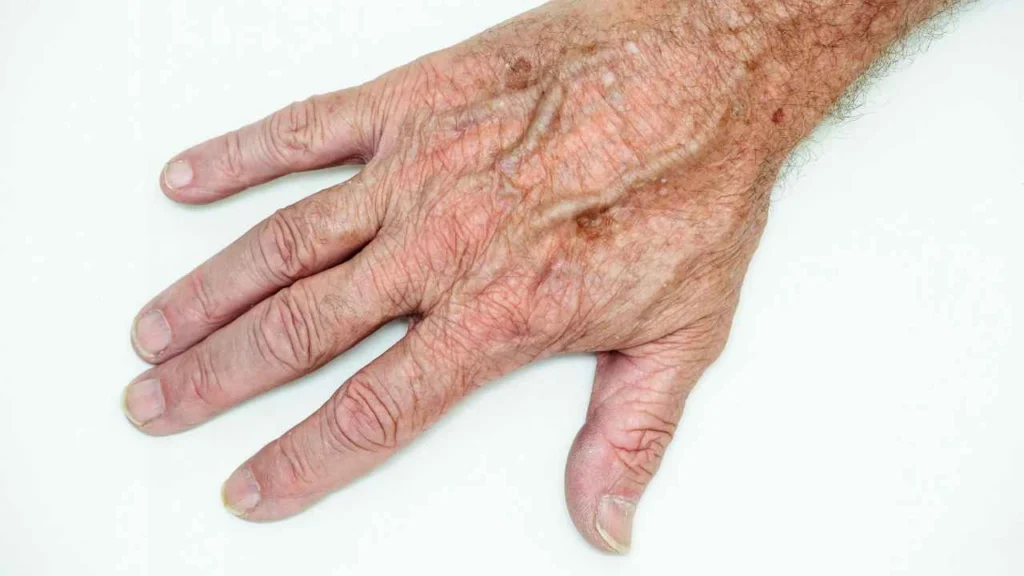 Male hand showing age spot Marlborough