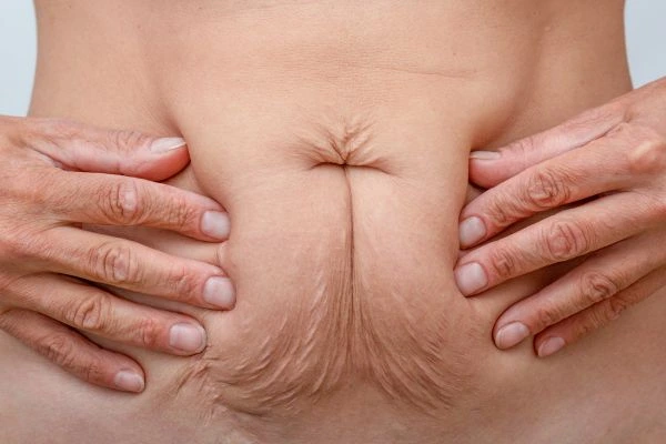 Image of a woman's stomach with loose skin - example of skin tightening Marlborough options