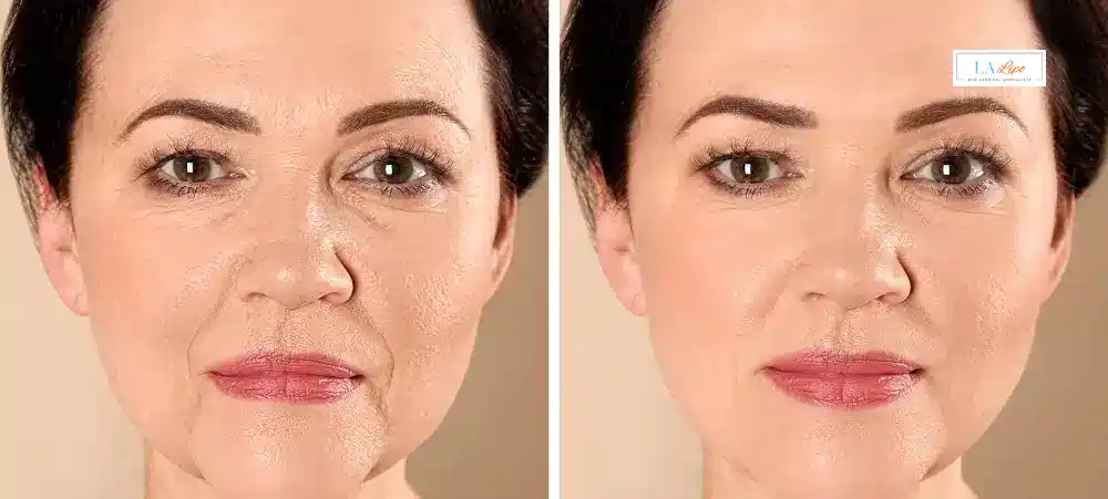 How Long Does It Take to See Results and How Long Do They Last Marlborough?