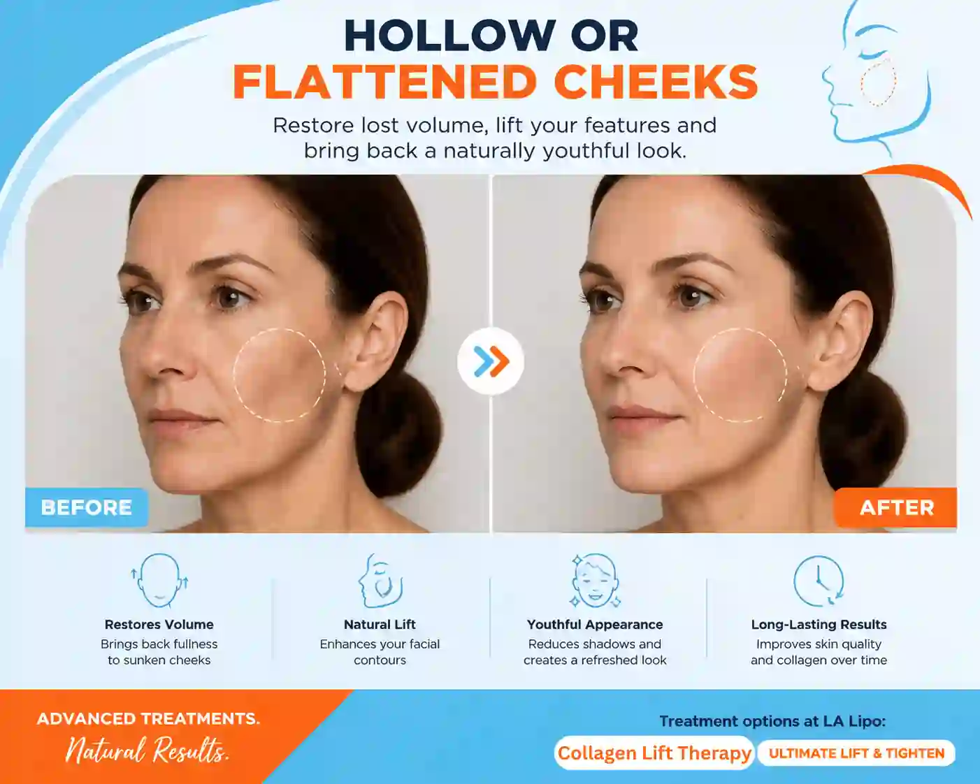 Sign #4: Hollow or Flattened Cheeks Marlborough