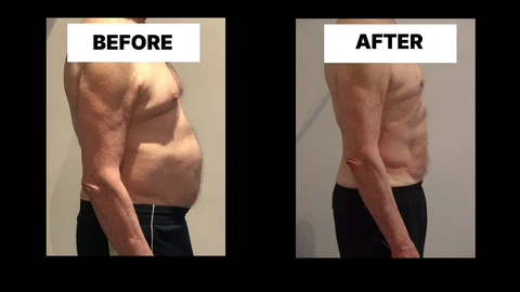 What Symptoms Can Diastasis Recti Cause in Men? Weak Core, Back Pain and Poor Posture Marlborough
